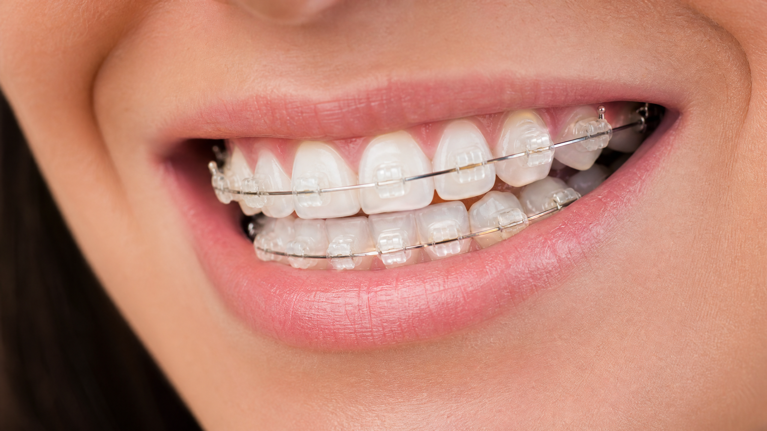 Aparelho Dental