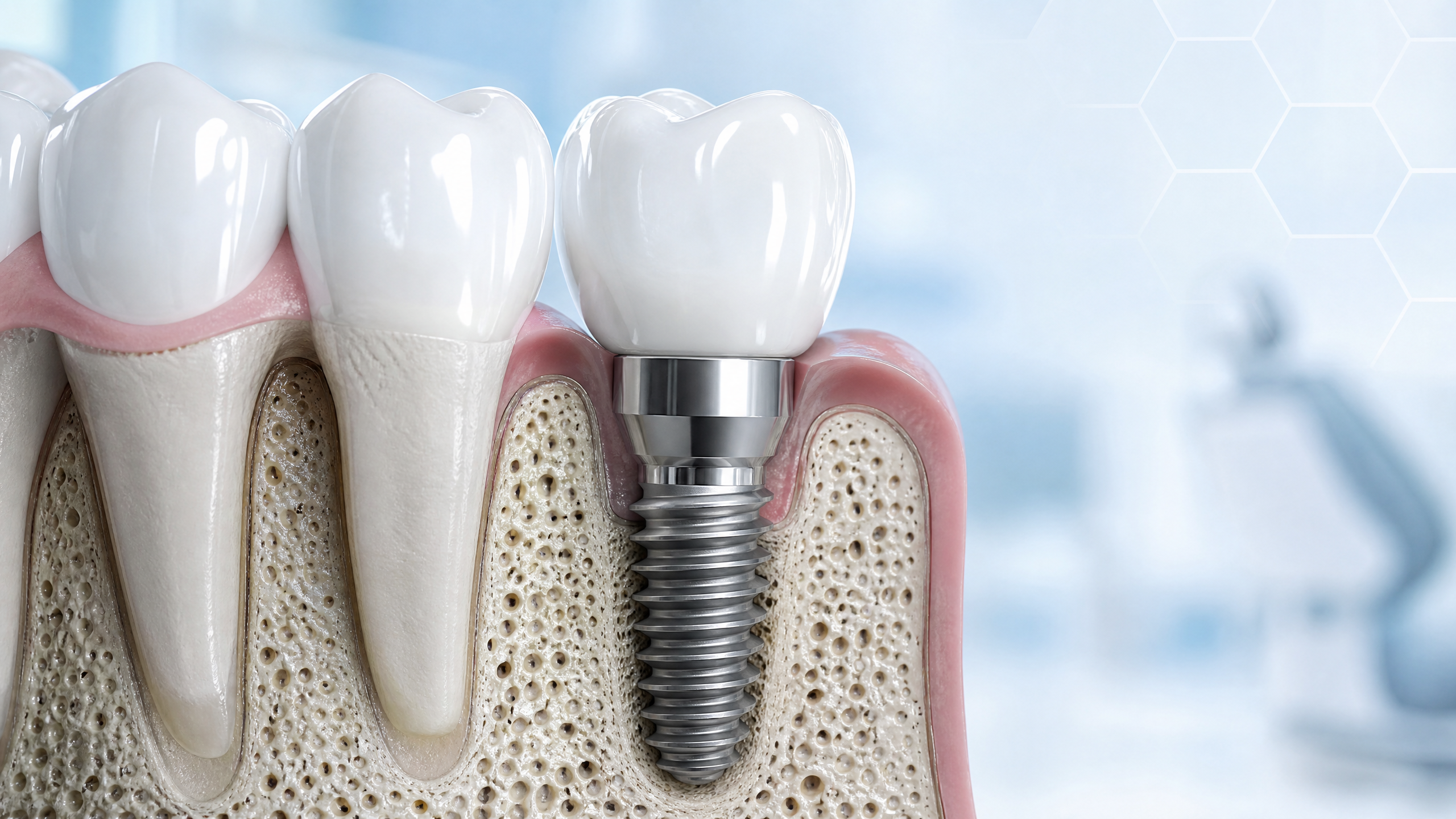 Implante Dentário